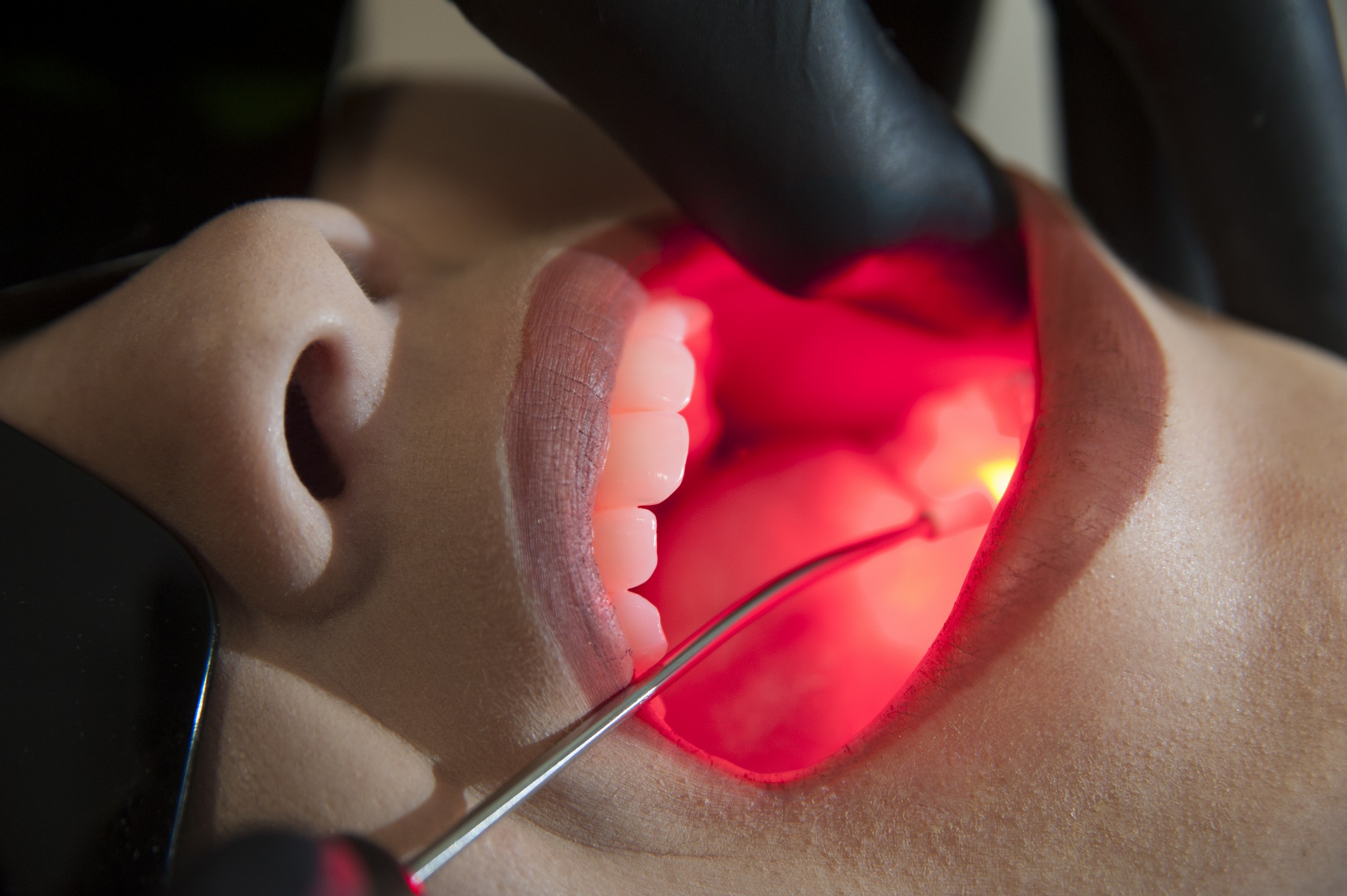 Laserterapia na Odontologia - Dr Liogi Iwaki