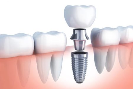 Implantes Dentários